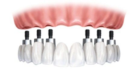 Prótesis atornillada