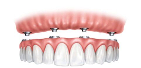 Prótesis removible sujeta a Locators