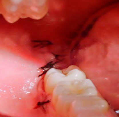 Extracción muelas del juicio