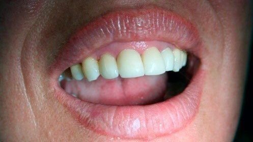 Coronas de circonio en los incisivos centrales