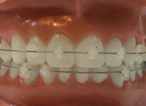Brackets estéticos de zafiro o zirconio