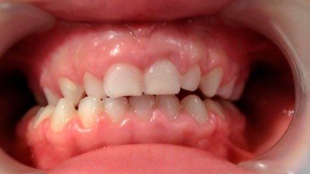 Ortodoncia interceptiva