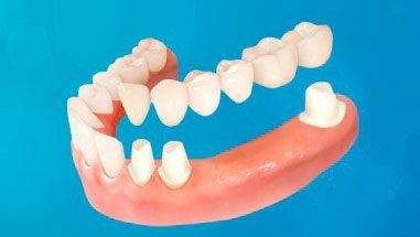 Puente de seis piezas