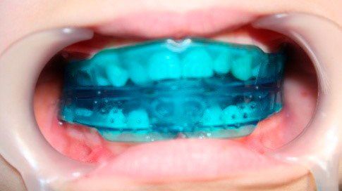 Ortodoncia interceptiva