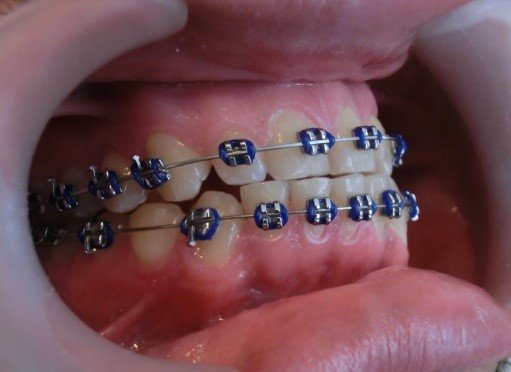 Brackets metálicos Brackets metálicos