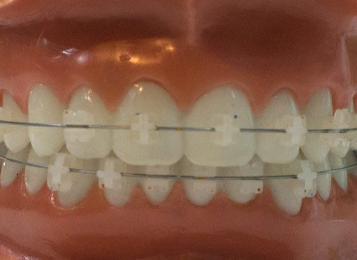 Brackets estéticos de zafiro o zirconio Brackets estéticos de zafiro o zirconio